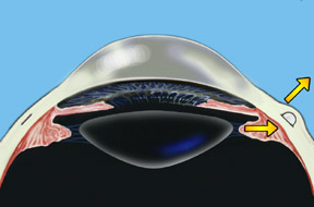 Scleral Implants El Cerrito