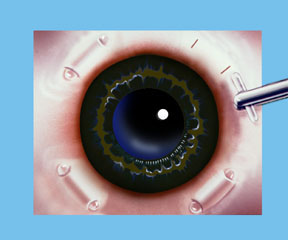 Eye Stent