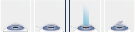 LASIK Eye Surgery San Francisco LASIK Eye Surgery Procedure Diagram