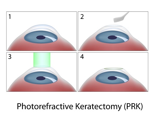 PRK Surgery Diagram