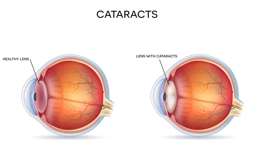 Cataracts San Francisco Cataracts Diagram
