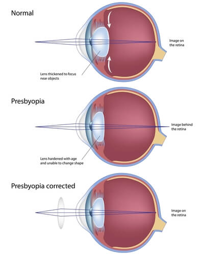 Presbyopia San Francisco Presbyopia Diagram