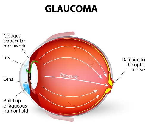 Glaucoma San Francisco Glaucoma Diagram