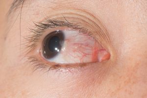 pterygium