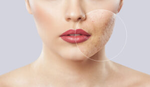 Example of Acne Scar with Microneedling