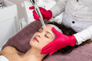 Woman having Microneedling in El Cerrito