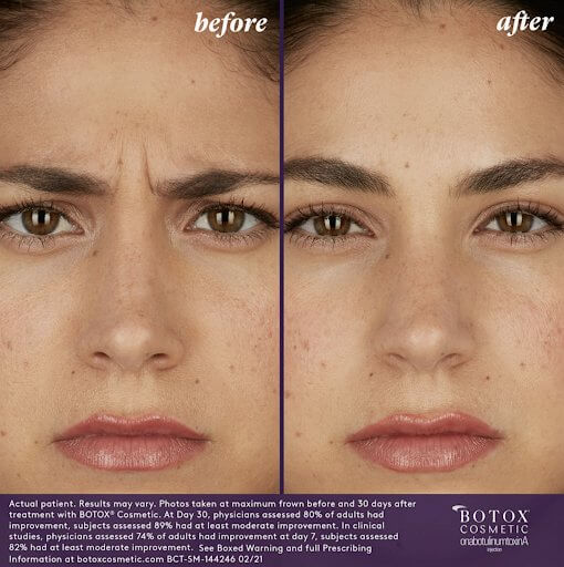before and after botox
