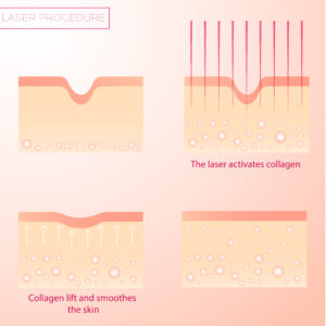 diagram of laser skin resurfacing procedure